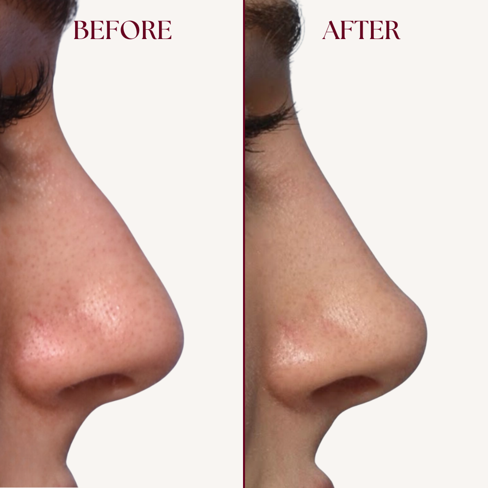 Nose Lifter