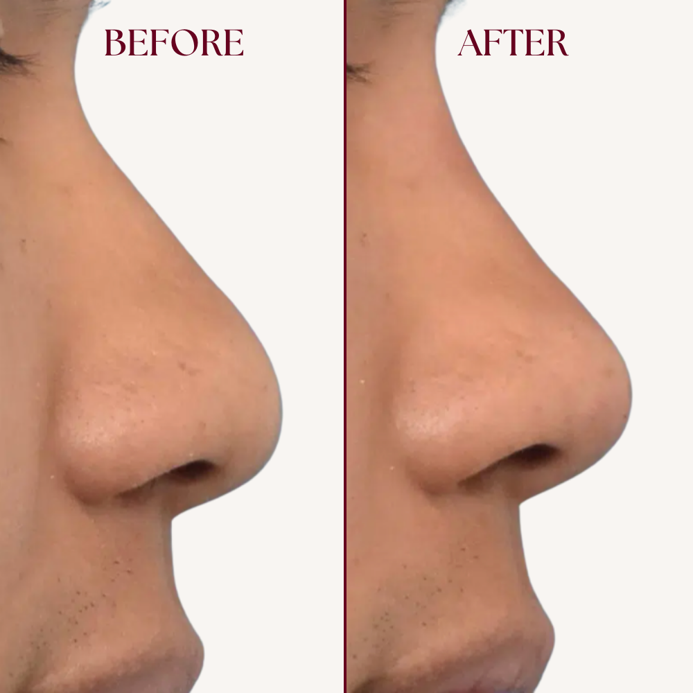 Nose Lifter