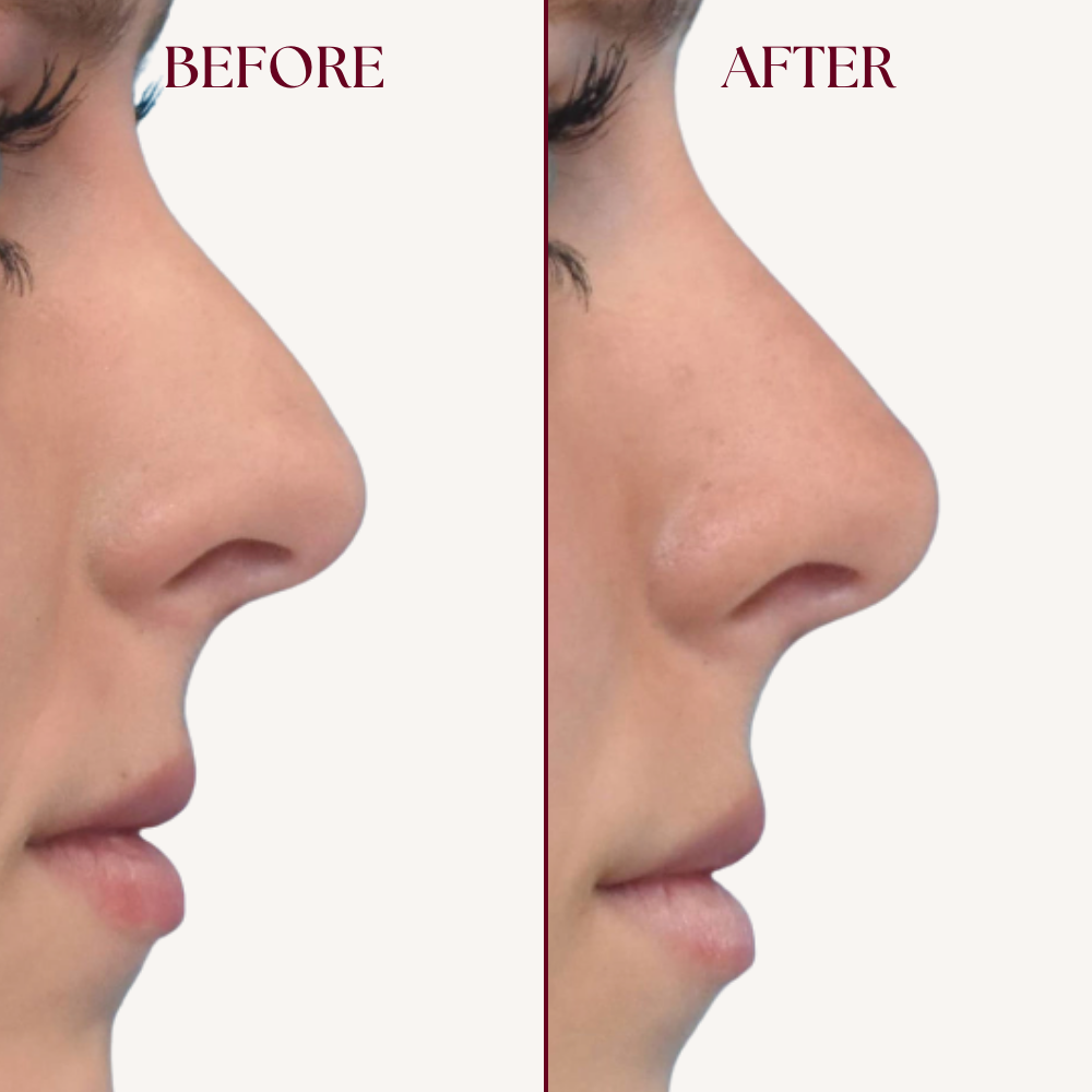 Nose Lifter